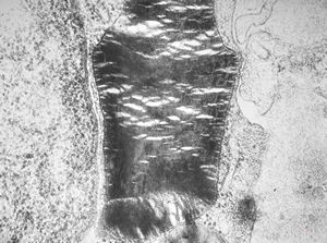 M,27y. | sea-blue histiocyte syndrome